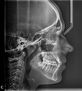 zdjęcie cefalometryczne ortodoncja gdynia