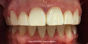 po użyciu preparatu ICON, Deodent- ortodoncja Gdynia