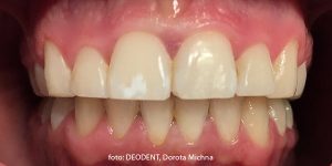 przed użyciem preparatu ICON, Deodent- ortodoncja Gdynia